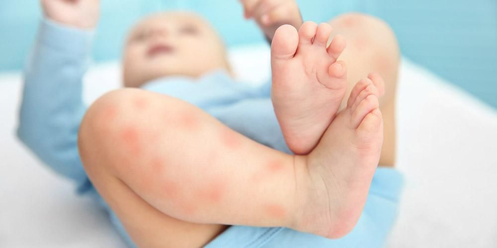 penyebab alergi pada bayi